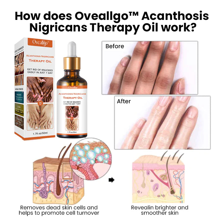 Oveallgo ™ زيت العلاج Acanthosis Nigricans